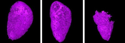 From left to right, micro-CT scans show decreasing visibility of contrast (violet) in the lymph node as tumors grow within. Images courtesy of Tohoku University.