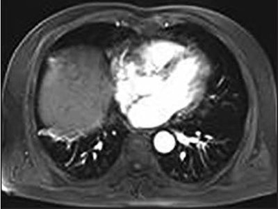 Abdominal contrast-enhanced MR image acquired three months after cryoablation procedure. No enhancement surrounds the tumor ablation zone, and the ablation zone is diminishing in size. Image courtesy of AJR.