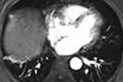 2019 03 19 20 56 6761 Mri Hcc Cryoablation Wang 20190319203427