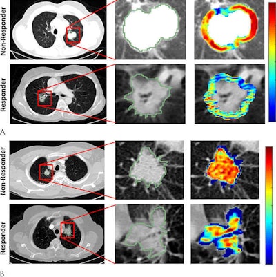 Radiomic feature maps of pretreatment CT show differences between lesions in responders and lesions in nonresponders. There appears to be overexpression of radiomic features (A, peritumoral Gabor, and B, intratumoral Laws features) in the nonresponder lesion compared with the responder lesion. The distribution of the features shows significant differences between the two lesion categories; these differences are captured by the skewness and kurtosis statistics of the feature distribution. Images courtesy of Radiology: Artificial Intelligence.