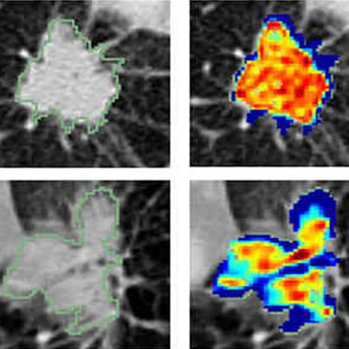 AI, radiomics can help predict chemotherapy response | AuntMinnie