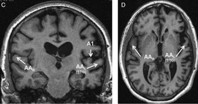 MRI scan from one of the four patients in the study, which linked auditory deficiencies to the superior temporal gyrus in the left hemisphere. Images courtesy of Northwestern University.