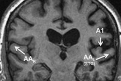 2019 03 22 22 09 6593 Mri Brain Dementia Auditory 20190322225131