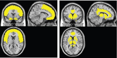 The MR images on the left show gray-matter atrophy commonly seen in a person with HIV. In the images on the right, the atrophy is associated with HIV-associated neurocognitive disorder, establishing a new profile for the disorder. All images courtesy of Xiong Jiang, PhD, and Georgetown.
