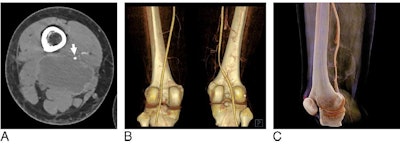 Visualization of a soft-tissue myofibroblastoma near the femoral artery of a 25-year-old woman using CT angiography (A), traditional volume rendering (B), and cinematic rendering (C). Image courtesy of Li et al. CC BY-NC 4.0.