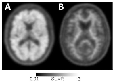 Amyloid-positive (left) and amyloid-negative (right) PET scans can be used to diagnose or rule out Alzheimer's disease in individuals with memory loss or cognitive decline. Images courtesy of UCSF Memory and Aging Center.