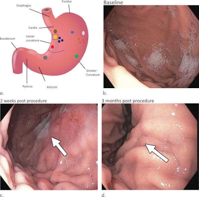Endoscopic images of a stomach ulcer observed in one participant at baseline (b), two weeks after bariatric embolization (c; arrow indicates a 1-cm superficial ulcer), and three months after embolization (d; arrow indicates prior location of ulcer). Images courtesy of RSNA.