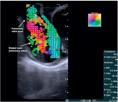 Vector flow imaging demonstrates swirl of blood flow within the dilated main pulmonary artery of a pig. Image courtesy of Dr. Morten Jensen, PhD.
