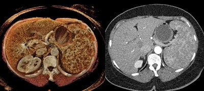 B-cell lymphoma of the spleen on a CT scan (right) and a cinematically rendered CT scan (left). All images courtesy of Dr. Elliot Fishman.