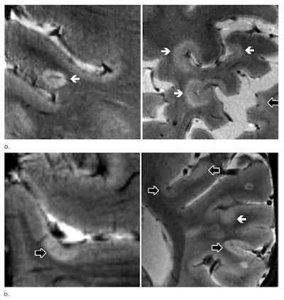 Axial 7-tesla T2-weighted images show examples of leukocortical lesions (white arrows) and intracortical lesions (black arrows) along with juxtacortical and periventricular white-matter lesions in different patients with MS. Images come from two different brain locations (a) in a 59-year-old man with secondary progressive MS (SPMS), and two different brain locations (b) in a 40-year-old woman with SPMS. Images courtesy of Radiology.