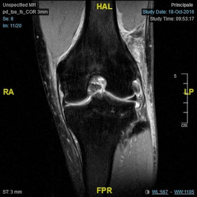 A preoperative MRI scan can be valuable in assessing damage to the anterolateral structures of the knee caused by an ACL injury. Image courtesy of Dr. Edoardo Monaco.