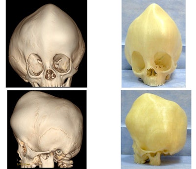 3D virtual skull model based on patient CT scans (left). 3D-printed craniofacial model (right). Images courtesy of Dr. Feras Alshomer.
