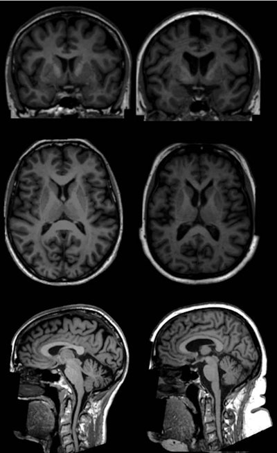 T1-weighted brain MR images show examples (coronal, top; axial, middle; and sagittal, bottom) of two women (age 65) in the U.K. Biobank study. One subject has a body fat percentage of 13% (left), while the other woman has a body fat percentage of 49% (right). MR images show lower volumes of subcortical gray matter structures in the individual with higher total body fat percentage (right). Images courtesy of Radiology.