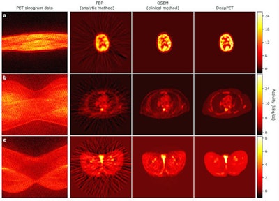 The series of PET images includes the cross sections of a brain (top), abdomen (middle), and hip (bottom). Each row depicts network input prior to reconstruction (sinogram), an older interpretation of data (FBP), the current method of interpretation (OSEM), and DeepPET, which produces smoother images and sharper detail compared with the other methods. Images courtesy of Häggström et al.