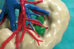 2019 04 25 00 45 1181 3 D Printed Kidney Tumor 400
