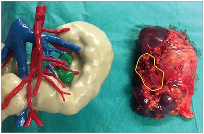 Kidney specimen (right) with corresponding 3D-printed kidney (left). The Wilms tumor is outlined in yellow in the kidney specimen and colored green in the 3D-printed model. Image courtesy of Wellens et al. Licensed under CC BY.