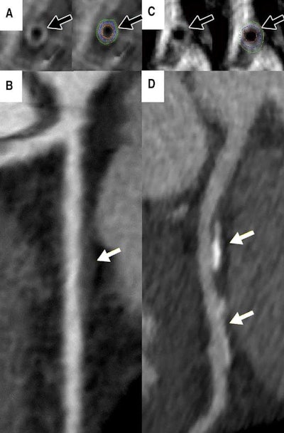 A: Cardiac MRI in a 46-year-old asymptomatic woman shows measured vessel wall thickness of 1.3 mm (black arrows). B: CT angiography shows noncalcified plaque (white arrow) in the proximal left anterior descending coronary artery. C: Cardiac MRI in a 44-year-old asymptomatic woman shows thicker coronary vessel wall (black arrows). D: CT angiography shows coronary artery disease (white arrows). Courtesy of the Radiological Society of North America.