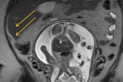 2013 04 19 12 35 28 586 2013 04 22 Mri Appendicitis 20190508231108