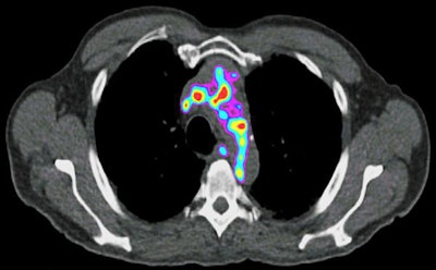 Atherosclerotic plaque shows up as colored regions in a PET scan of a human artery. Image courtesy of Yongjian Liu, PhD, and Washington University School of Medicine.