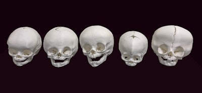 3D-printed skulls based on CT scans. Image courtesy of Dr. Sumit Pruthi.