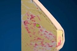 2019 05 09 20 03 6020 Breast Cinematic Rendering 400