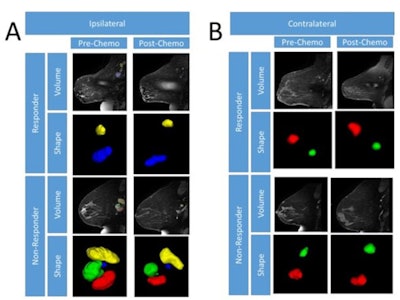 Representative MR images of ipsilateral (A) and contralateral (B) axillary lymph nodes modified in both size and shape before and after chemotherapy for a complete responder and nonresponder. Shape images are magnified to more easily see margins. Images courtesy of ISMRM.