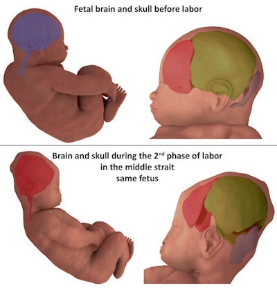 3D finite element reconstruction of the cranial bones before labor and during the second stage of labor. Image courtesy of Dr. Olivier Ami.