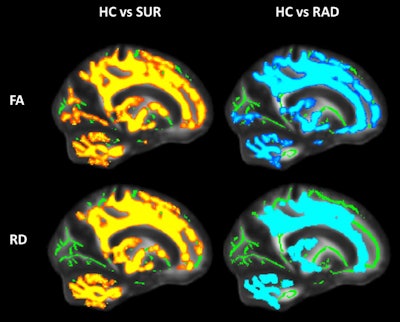 MR images compare fractional anisotropy (FA) and radial diffusivity (RD) between the surgery (yellow) and radiation (blue) patient groups and healthy controls. Colored areas indicate significant brain regions showing decreased FA and increased RD within patient groups. Mean FA skeleton is shown in green. Images courtesy of ISMRM.