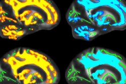 2019 05 15 23 39 6469 Ismrm Mri Kids Brain Tumors 20190515232744 jpg