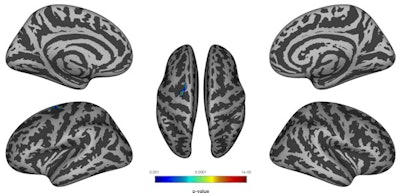 Significantly reduced cortical thickness (p < 0.05) was found in the superior part of the left precentral sulcus (shades of blue, green, and red) in children prenatally exposed to chemotherapy. Results are corrected for gestational age. Image courtesy of the ISMRM.