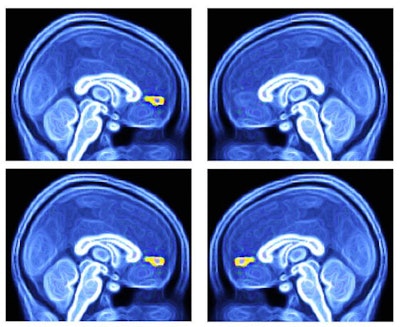 Among children with ASD, the brain's ventral medial prefrontal cortex (yellow) activates normally when they view their favorite objects but does not respond (top right, missing yellow) when they see their favorite faces. Among typically developing children, the region reacts normally (bottom left and right, yellow) to seeing favorite faces and objects. Images courtesy of Wake Forest Baptist Health.