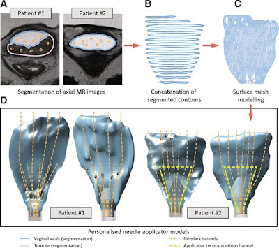 Workflow for creating 3D-printed brachytherapy applicators based on MRI data. Image courtesy of Laan et al. Licensed under CC BY 4.0.