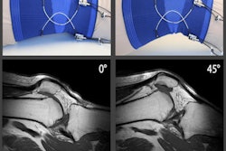 2019 05 24 17 03 1459 Flexible Mr Coil Am Mri Insider 400