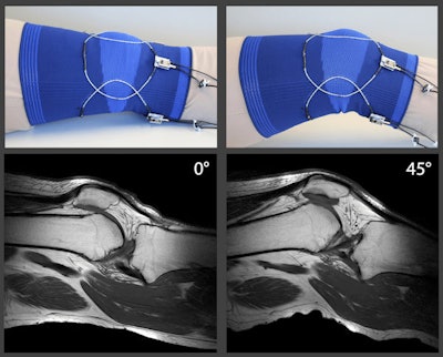 In vivo MR images are from a healthy volunteer's knee at two different flexion angles. The array was tuned and matched for the 0° position only, and no further adjustments were made for the 45° position. Images courtesy of ISMRM.