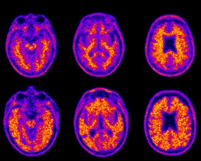 Florbetapir-PET scans show the brain of a cognitively healthy 74-year-old (top row) who demonstrated average financial skills, compared with an 86-year-old with mild Alzheimer's disease (bottom row) who demonstrated impaired financial skills. The bottom scan is positive for amyloid plaques, highlighted in yellow and orange throughout the brain and extending to its edges. Images courtesy of Duke Health.