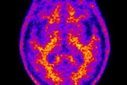 2019 05 29 22 58 3093 Florbetapir Pet Money Dementia 20190529225325