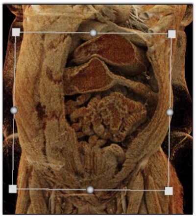 Cinematically rendered CT scan of the colon in patients with Crohn's disease (top) and ulcerative colitis (bottom). All images courtesy of Dr. Elliot Fishman.