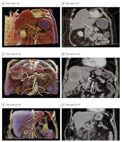 Cinematically rendered images (left column) juxtaposed with corresponding CT scans (right column) of pancreatic (A-B) and liver (C-F) anatomy. Images courtesy of Elshafei et al. Licensed under CC BY 4.0.