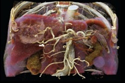 2019 06 06 16 07 6766 Cinematic Rendering Ct Edited 400