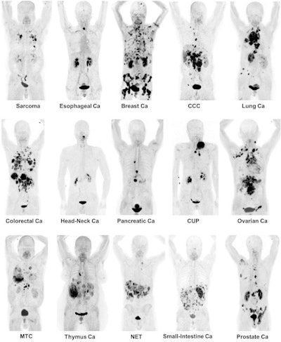 Maximum-intensity projection images of Ga-68 FAPI PET/CT in patients with 15 different histologically proven tumor entities (sorted by uptake in descending order). Ca = cancer; CCC = cholangiocellular carcinoma; CUP = carcinoma of unknown primary; MTC = medullary thyroid cancer; NET = neuroendocrine tumor. Images courtesy of Kratochwil et al and JNM.