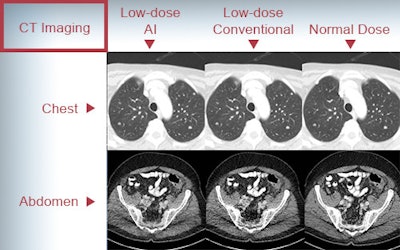 CT images of the chest and abdomen produced using, from left, low-dose AI reconstruction, low-dose conventional iterative reconstruction, and normal-dose CT. The image quality of low-dose AI is comparable and, in some cases, superior to conventional low-dose CT scans. It's also faster, according to the researchers. Image courtesy of the Ge Wang group at RPI and the Mannudeep Kalra group at MGH and Harvard Medical School.