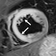 2019 06 12 18 11 5546 Cardiac Mri Cocaine Use Francone 400