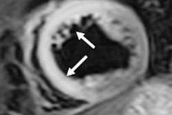 2019 06 12 18 11 5546 Cardiac Mri Cocaine Use Francone 400