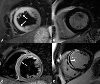 Cardiac MR images acquired from a 44-year-old woman with acute chest pain and chronic cocaine abuse for more than 10 years. Short-axis T2-weighted short tau inversion-recovery (STIR) image (A) demonstrates the presence of transmural edema (arrows) in the anteroseptal and inferoseptal myocardial segments (left descending artery's vascular territory). The late gadolinium enhancement (LGE) sequence in the same cardiac plane (B) did not show gadolinium deposition inside the myocardium. MR images also show an anteroseptal infarction with microvascular obstruction in a 38-year-old man with long-standing abuse of cocaine and troponin elevation. Edema (C) is in the anteroseptal wall (arrow). The short-axis LGE sequence (D) highlights transmural hyperintensity of the anteroseptal wall (arrow) with linear hypointensity (arrowhead) inside the microvascular obstruction. Images courtesy of Radiology: Cardiothoracic Imaging.