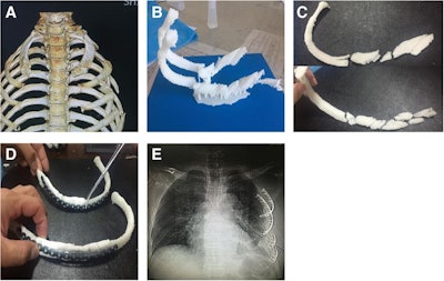 (A) Virtual 3D model of a patient's rib cage based on preoperative CT scans. (B) 3D-printed model of the fractured ribs. (C) 3D-printed model spliced and then reconstructed (D) onto titanium alloy rib-locking plates. (E) Postoperative chest x-ray showing restoration of rib structure. Images courtesy of Zhou et al. Licensed under CC BY 4.0.