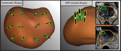 The illustration shows the difference between ultrasound- and MRI-guided methods to obtain tissue samples (black needles) from different regions in the prostate (brown oval object). MRI (right) allows doctors to detect lesions (green oval object) and take tissue samples from specific lesions. Images courtesy of UCLA Health.