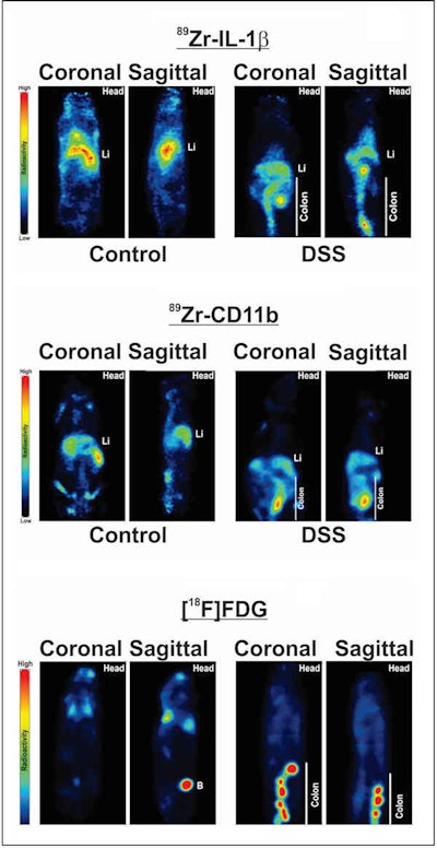 PET images show the detection of colonic inﬂammation by IL-1β, CD11b, and F-18 FDG (coronal and sagittal) of control and colitic mice. Images courtesy of Dmochowska et al and JNM.