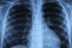 2019 06 20 19 40 2118 Lung X Ray Marker 400