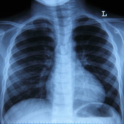 2019 06 20 19 40 2118 Lung X Ray Marker 400