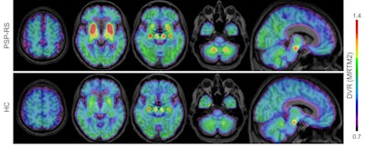 F-18 PI-2620 binding is easily discernable (red and yellow) in axial and sagittal slices from PSP patients (upper row) and healthy controls (lower row) in an MRI template. Images courtesy of Dr. Mattias Brendel et al and SNMMI.